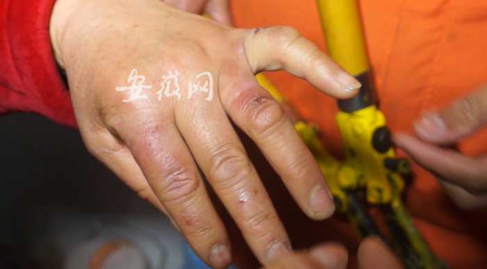 孕妇产前手指浮肿 消防员用老虎钳等帮其取戒指