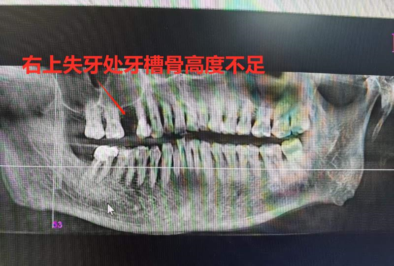 牙槽骨骨量不足难种植医生用上颌窦外提升术完成荒漠种牙