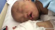 安徽宿州這名5歲小女孩渾身傷痕、傷口發臭、指甲脫落！警方已展開調查