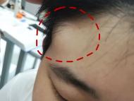 陪兒子看病，自己卻被查出腸道長了上百個息肉 醫生：罕見家族遺傳病