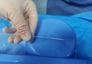 生物可降解支架讓患者不再“堵心”   安醫(yī)大四附院在安徽率先開展手術(shù)