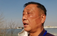 合肥一社居委主任戰疫二十多天  曬成“口罩臉”（圖）