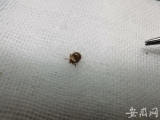 肥西一隔离人员遭蜱虫咬伤  医务人员紧急处理