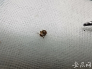 蜱蟲鉆進(jìn)八歲男孩頭頂  專家提醒：身上冒出小黑點(diǎn)別大意