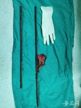 男子高处坠落两根钢筋从腹部贯穿至上臂   获及时救治近期出院