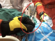 險！桐城一工人被鋼筋直插頭部，消防、醫生共同營救