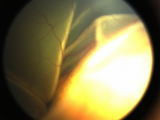 2月龄宝宝患眼癌 专家呼吁：千万不要忽视新生儿眼病筛查