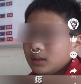 合肥一男孩鼻卡钥匙环秒变牛魔王 疼痛难忍求助消防