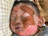 幼童被烫伤面部续：两天接受募捐四万余元  将到合肥咨询治疗方案 