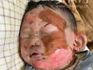 幼童被燙傷面部續：兩天接受募捐四萬余元  將到合肥咨詢治療方案 
