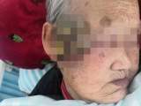 九旬老人被肿瘤“吞”掉小半张脸 安医大四附院成功为其“换脸”
