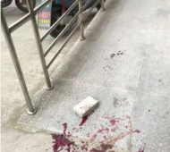 12歲女孩被“天降青磚”砸中追蹤  現已撤下呼吸機  肇事者父母已累計送了五萬元治療費