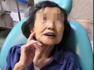 合肥90歲老人缺牙40多年 裝上吸附性義齒輕松啃蘋果
