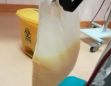 合肥：这位孕妈妈因腹痛入院 体内抽出血液竟呈“牛奶色”