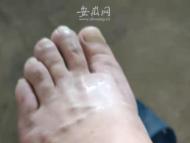 舒城一輔警腳腫成了“蘿卜”仍堅守防疫一線  被強制休息