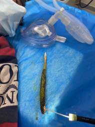 腹痛持續半年 合肥小伙腹內取出20厘米牙刷柄