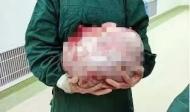 古稀之年身懷“怪胎”    專家妙手巧卸“重負”