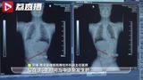 仅3周接诊5名下腰瘫痪孩子！家长一定要注意