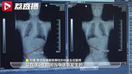 僅3周接診5名下腰癱瘓孩子！家長(zhǎng)一定要注意