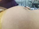 19岁未婚未育女子腹内长肿瘤，剖开竟然有头发、牙齿等人体组织