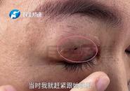 雙眼皮修復(fù)后竟多了個(gè)洞 ？當(dāng)事人稱“閉眼能看到外面 刮風(fēng)眼睛就跑風(fēng)”