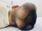 5岁男童患“超级罕见病”，国内此前仅报道过1例