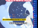 37岁男子肺部发现557个磨玻璃结节 医生也大为震撼