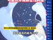 37歲男子肺部發現557個磨玻璃結節 醫生也大為震撼