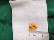 73歲老人氣管里“拔”出一顆牙