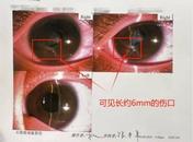 10歲哥哥被剪刀劃破眼球 原是為了幫幾個月的妹妹換紙尿褲