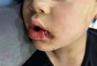 嘴角撕裂、牙齒斷裂縫11針……6歲男童與同伴打鬧受傷，家長(zhǎng)提賠償；對(duì)方如此回復(fù)