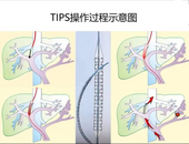 反復(fù)消化道出血、腹瀉！安徽一醫(yī)院技術(shù)創(chuàng)新為患者成功開(kāi)展高難度介入手術(shù)  