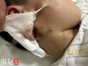 河南3歲男童被惡犬咬傷18天后離世，男童母親發聲