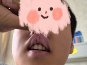 孩子脸部、手脚长黑斑  专家：警惕癌变！