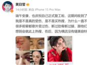 網傳女演員黃日瑩武訓時受傷，臉部縫了7針，本人曬照回應