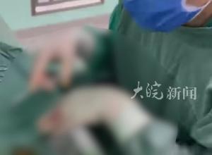 常年不吃早餐，39岁男子胆囊内取出247颗结石
