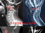 7歲男童突然高位截癱， CT上看就像成了“斷頭人”，病因是……