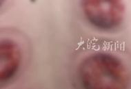 男子自行在家拔火罐，背上燙滿密密麻麻的小水泡，被診斷為II度燒傷