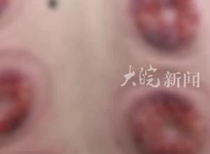 男子自行在家拔火罐，背上烫满密密麻麻的小水泡，被诊断为II度烧伤