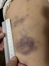青島10歲男童遭托管班教師毆打，身體大片淤青 涉事老師被行拘，教體局回應