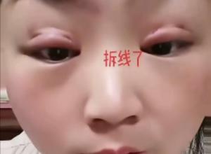女子做双眼皮结果失败了?
“每天醒来眼睁不开 修复也没用” 
询问网友:我这咋整?
