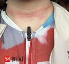 太突然！95后姑娘騎行比賽被風箏線“割喉”