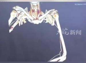 黑龙江勃利县一村民被老虎咬伤 医生：患者仍在ICU 人很乐观 手术后发现口腔巴斯德菌