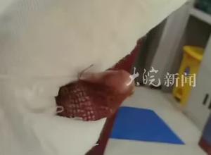 烧伤妈妈最新恢复情况  左手手指能动了 丈夫：她坚强地把手举起来 是告诉我别担心
