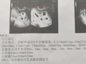 女子懷九胞胎，最終留下兩胎