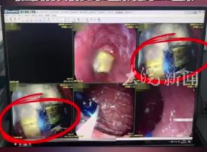 南昌一男子误吞9厘米长打火机，医生用圈套器慢慢取出