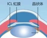 合肥瑶海普瑞眼科寒假摘镜总动员| ICL晶体植入眼内有保质期吗？能管多久？