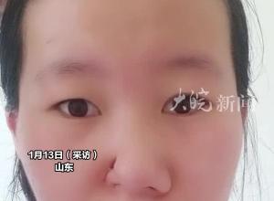女生鼻子上长出大洞，在额头上养出了个新鼻子，“还在恢复中 比以前自信多了”