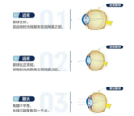 「合肥爱尔眼科」近视能不能被治愈？