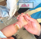 1歲幼童被502膠水“燒傷”  局部皮膚壞死需植皮